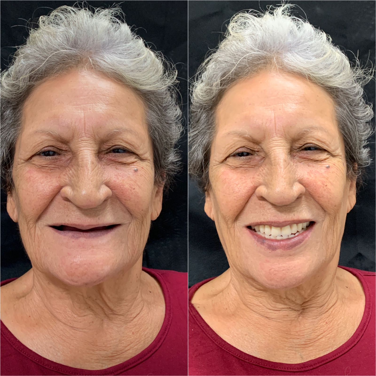 Antes e depois da prótese protocolo sobre implantes da paciente Dona Ignês