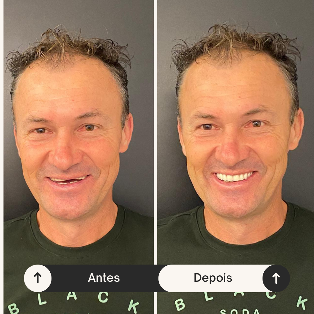 Antes e depois da prótese protocolo sobre implantes do paciente Delmir