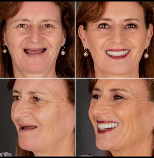 Antes e depois da prótese protocolo sobre implantes da paciente Lourdes